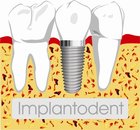 implantodent medical